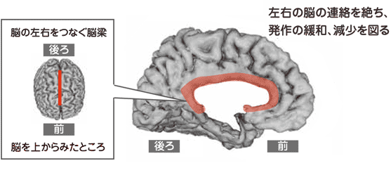 脳の左右をつなぐ脳梁を上からみた図「左右の脳の連絡を絶ち、発作の緩和、減少を図る」