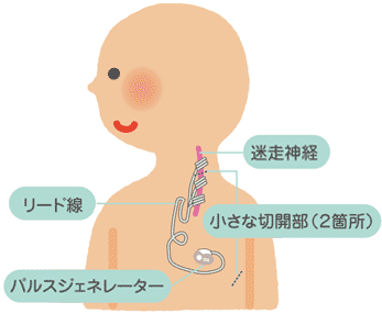 迷走神経刺激療法の図「迷走神経」「リード線」「小さな切開部（2カ所）」「パルスジェネレーター」